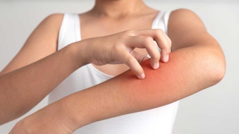 Skin Allergies को तुरंत रोकने के 7 आसान तरीके