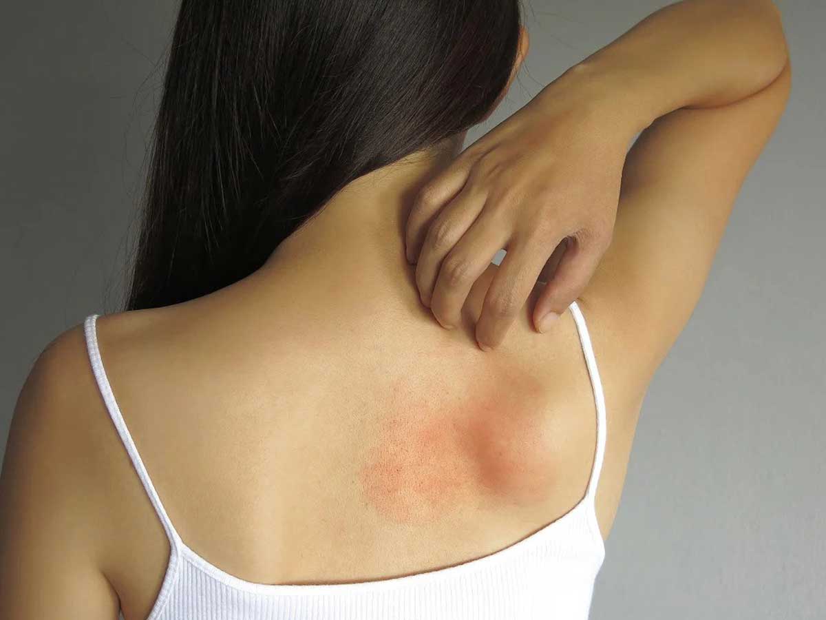 Easy ways to stop skin allergies immediately