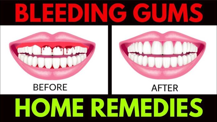 Home Remedies and Natural Ways for Bleeding Gums