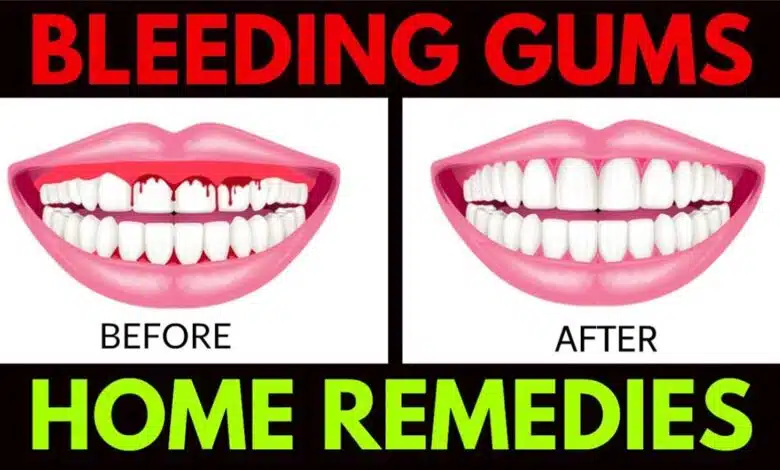 Home Remedies and Natural Ways for Bleeding Gums