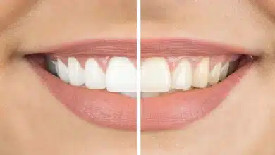 Home remedies for yellow teeth