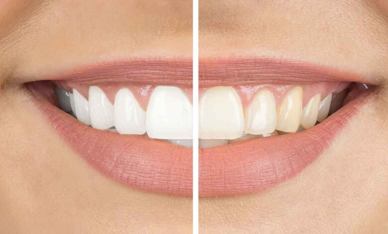 Home remedies for yellow teeth