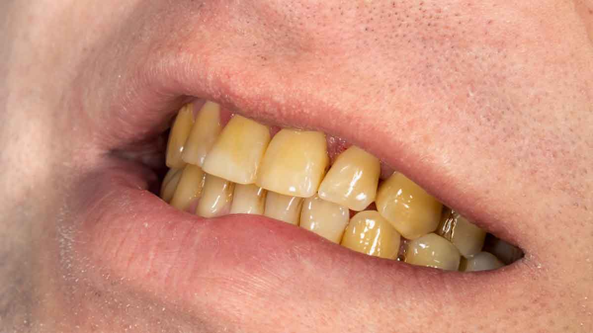 Home remedies for yellow teeth