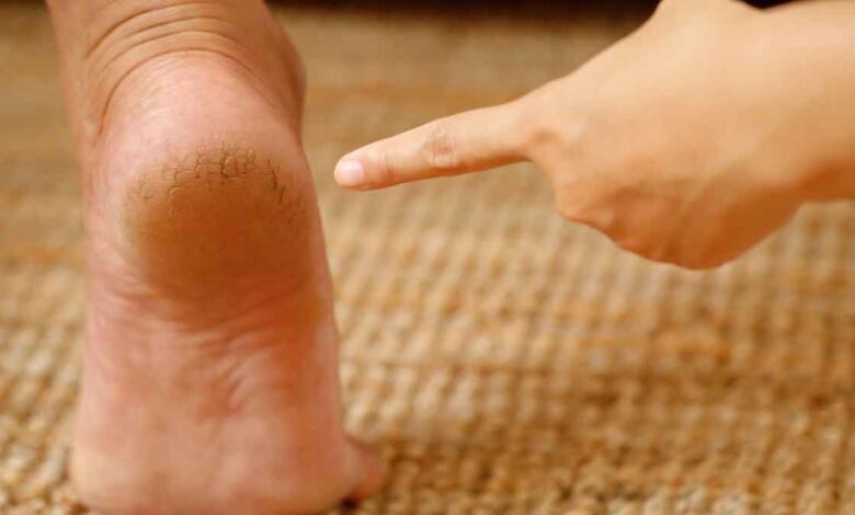 This Desi Cream cures cracked heels in 1 week