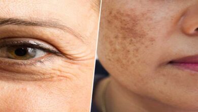 What happens to the face due to deficiency of Vitamin C?