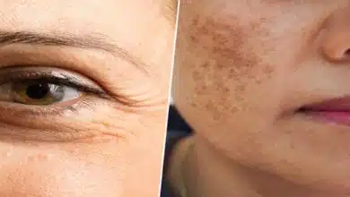 What happens to the face due to deficiency of Vitamin C?