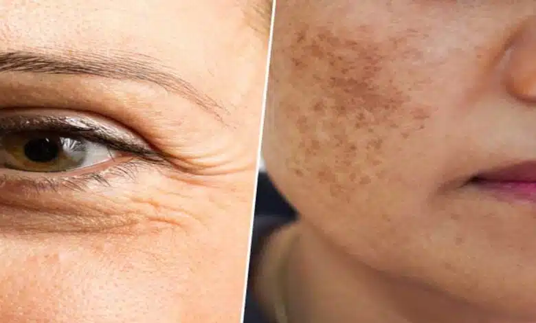 What happens to the face due to deficiency of Vitamin C?