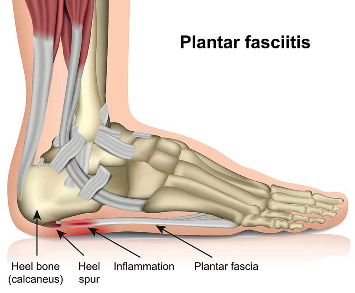 What is Plantar Fasciitis and how to treat it