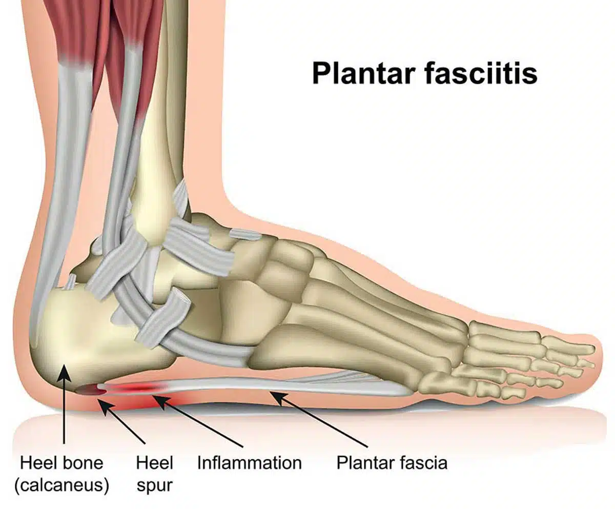What is Plantar Fasciitis and how to treat it 3 What is Plantar Fasciitis and how to treat it