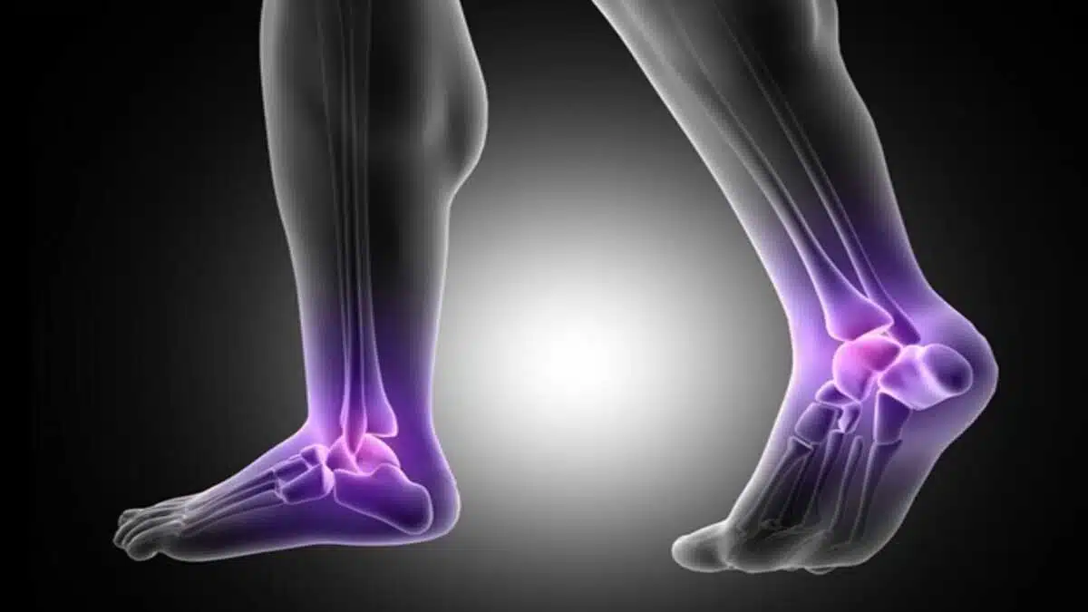 What is Plantar Fasciitis and how to treat it 4 What is Plantar Fasciitis and how to treat it