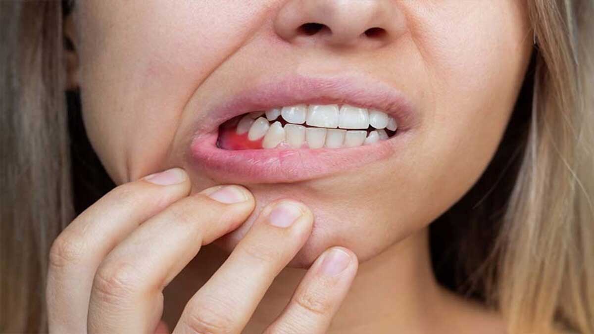 Home Remedies and Natural Ways for Bleeding Gums