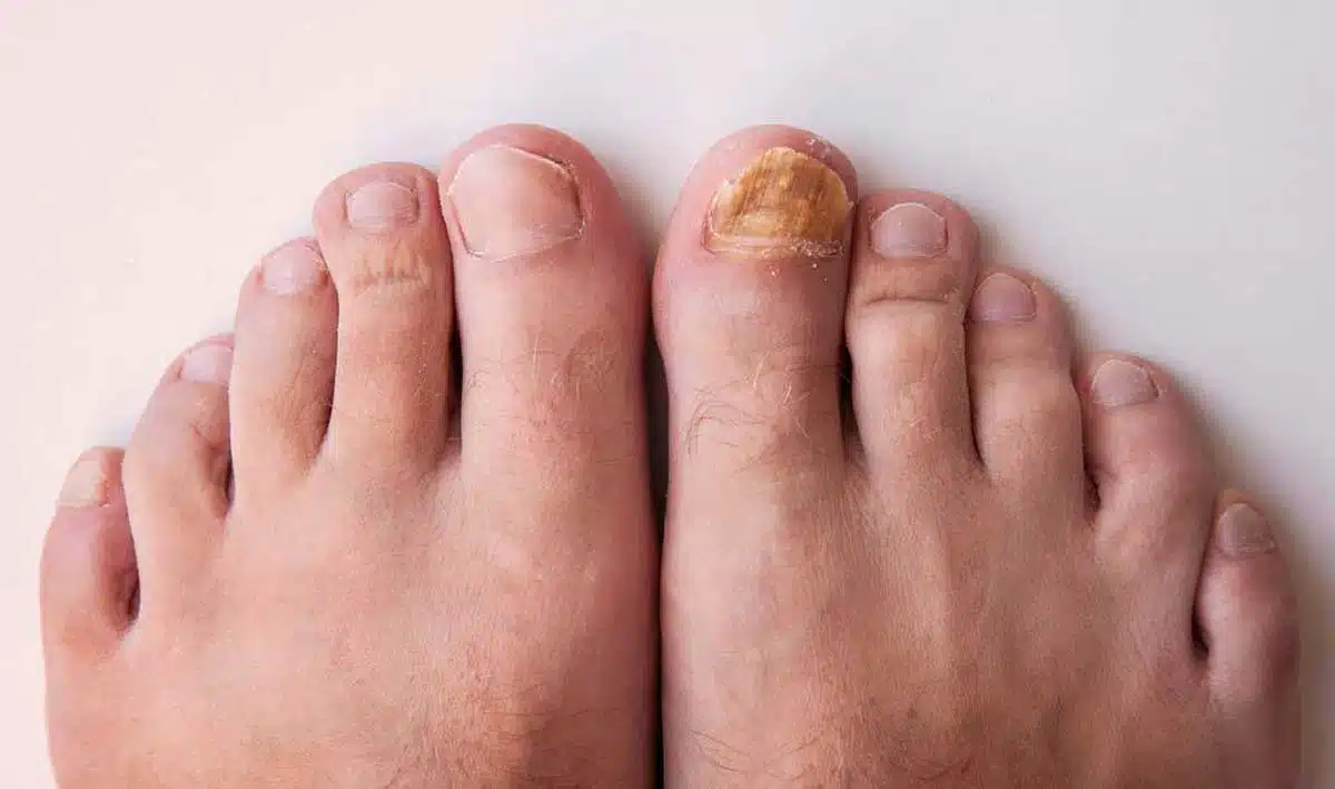 Use tea tree oil to get rid of nail fungus