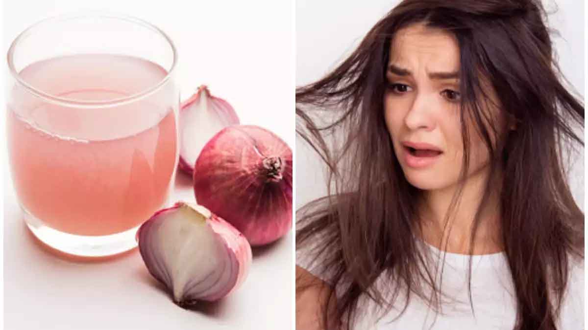 Apply Onion juice to your hair in this way, hair fall will stop and hair growth will also be good