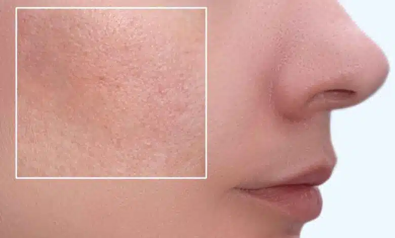 Best face packs to close your Open Pores