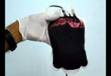 CMHO dismissed 3 people in blood black marketing case in Madhya Pradesh