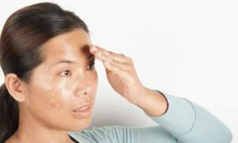 Dark Spots Removal If the dark spots on your face are not leaving you, then make a natural cream with alum