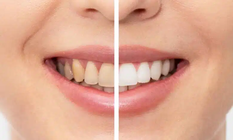 Four fruits recommended by dentists to whiten your Teeth