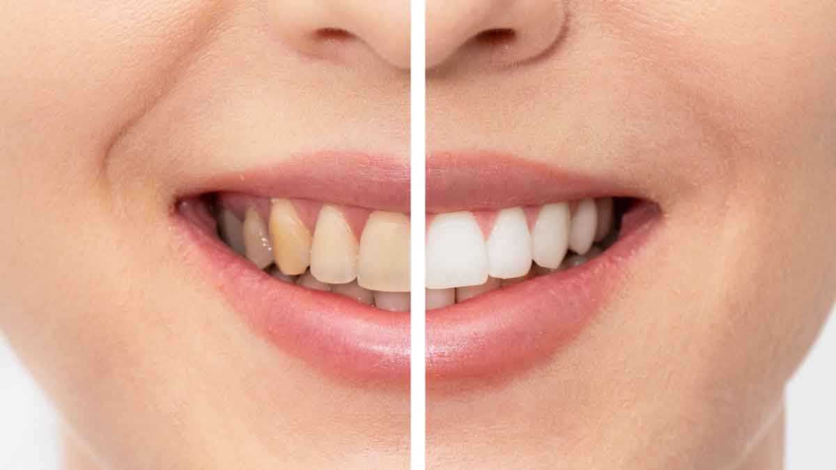 Four fruits recommended by dentists to whiten your Teeth