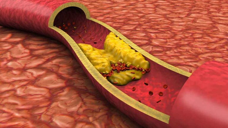 Cholesterol: यह घरेलू उपाय खराब कोलेस्ट्रॉल को पिघलाकर दूर कर देगा