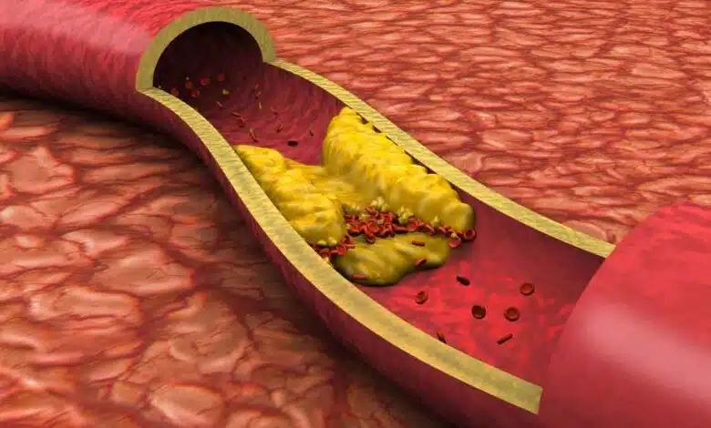 This home remedy will melt the bad Cholesterol and remove it