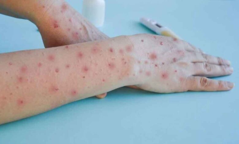 Delhi's suspected Mpox patient tests negative