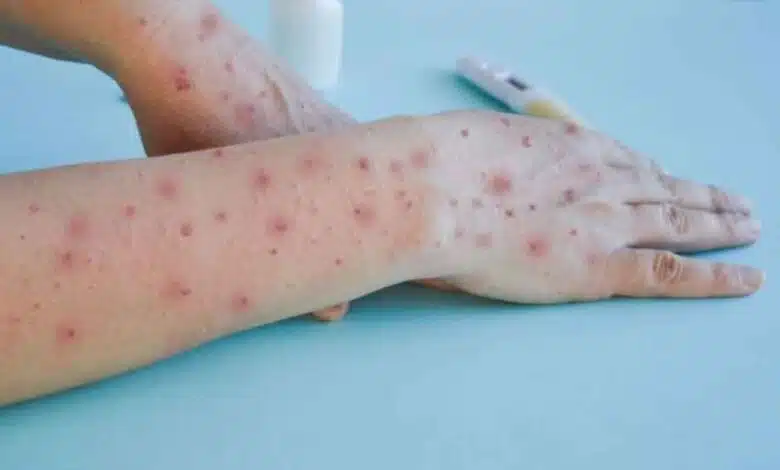 Delhi's suspected Mpox patient tests negative