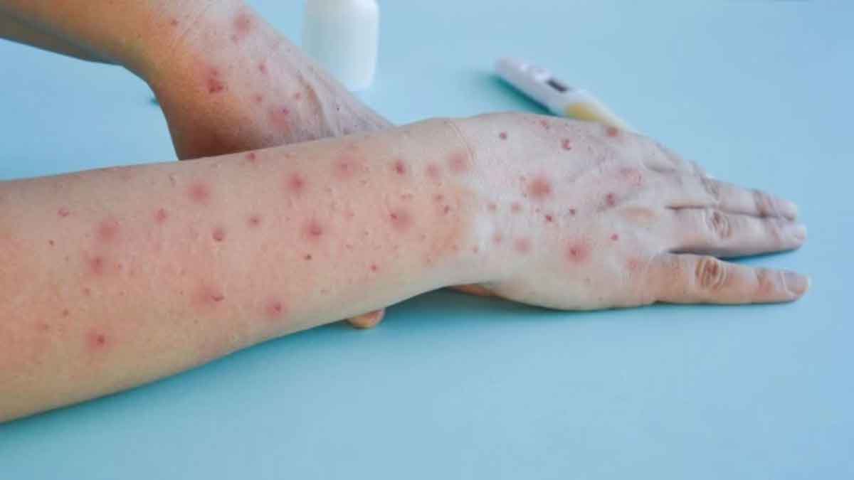 Delhi's suspected Mpox patient tests negative