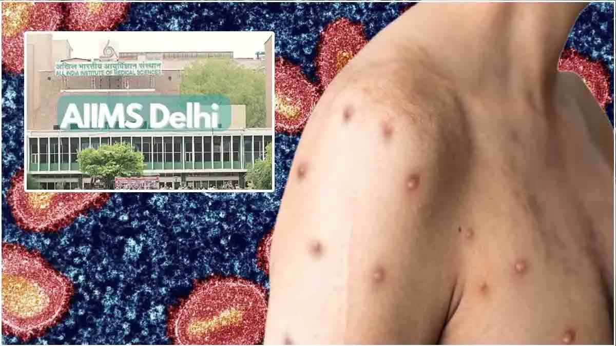 Delhi's suspected Mpox patient tests negative