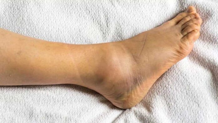 Swollen Ankles? What are the 10 common causes?