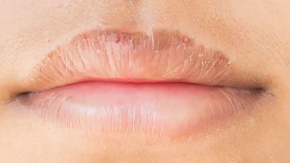 Which disease can be caused by applying lipstick