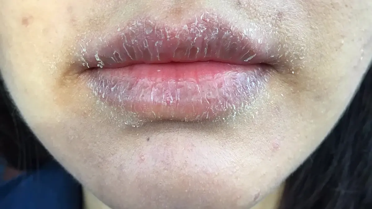 Which disease can be caused by applying lipstick