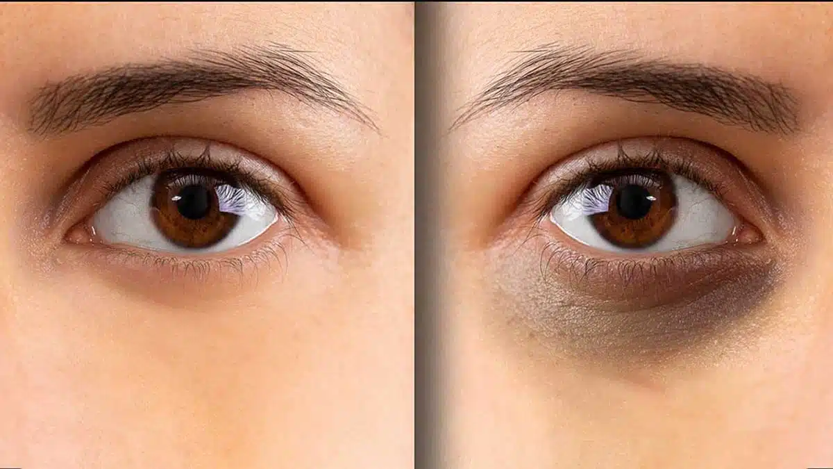 dark circle 1 Try these 5 home remedies to remove dark circles