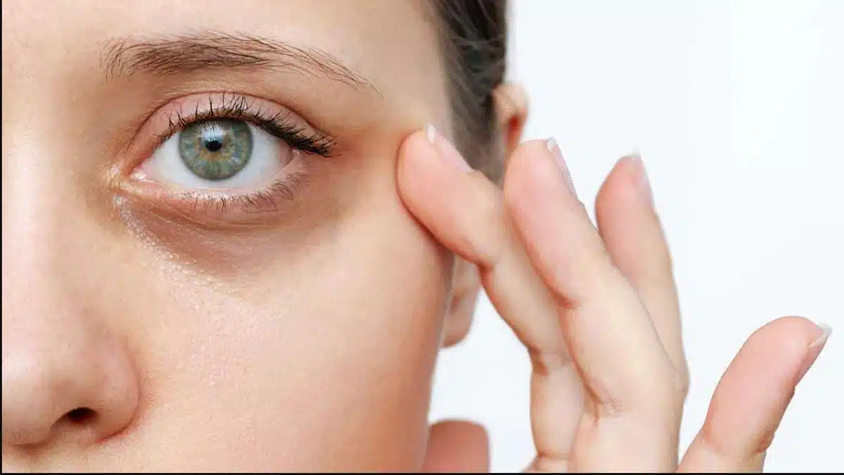 dark circle 2 Try these 5 home remedies to remove dark circles