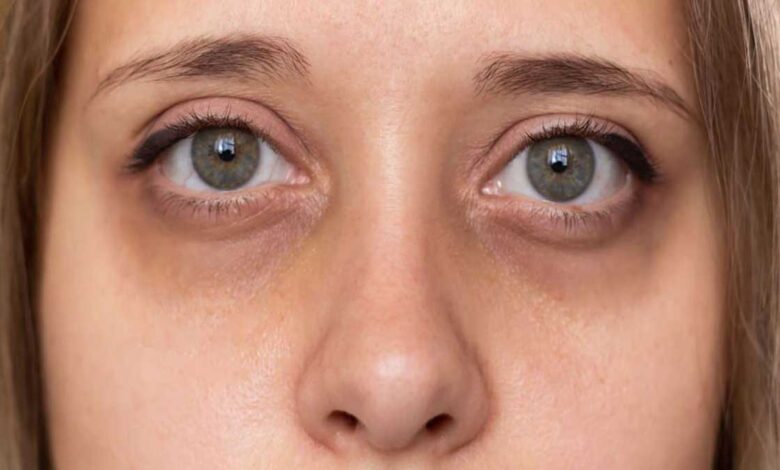 Try these 5 home remedies to remove dark circles