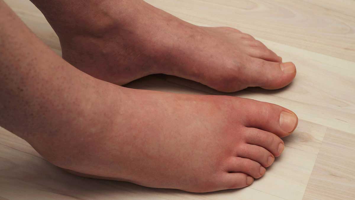 Swollen Ankles? What are the 10 common causes?