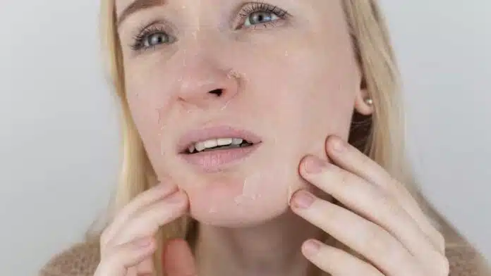 Eliminate Dry Skin the magic of home remedies!