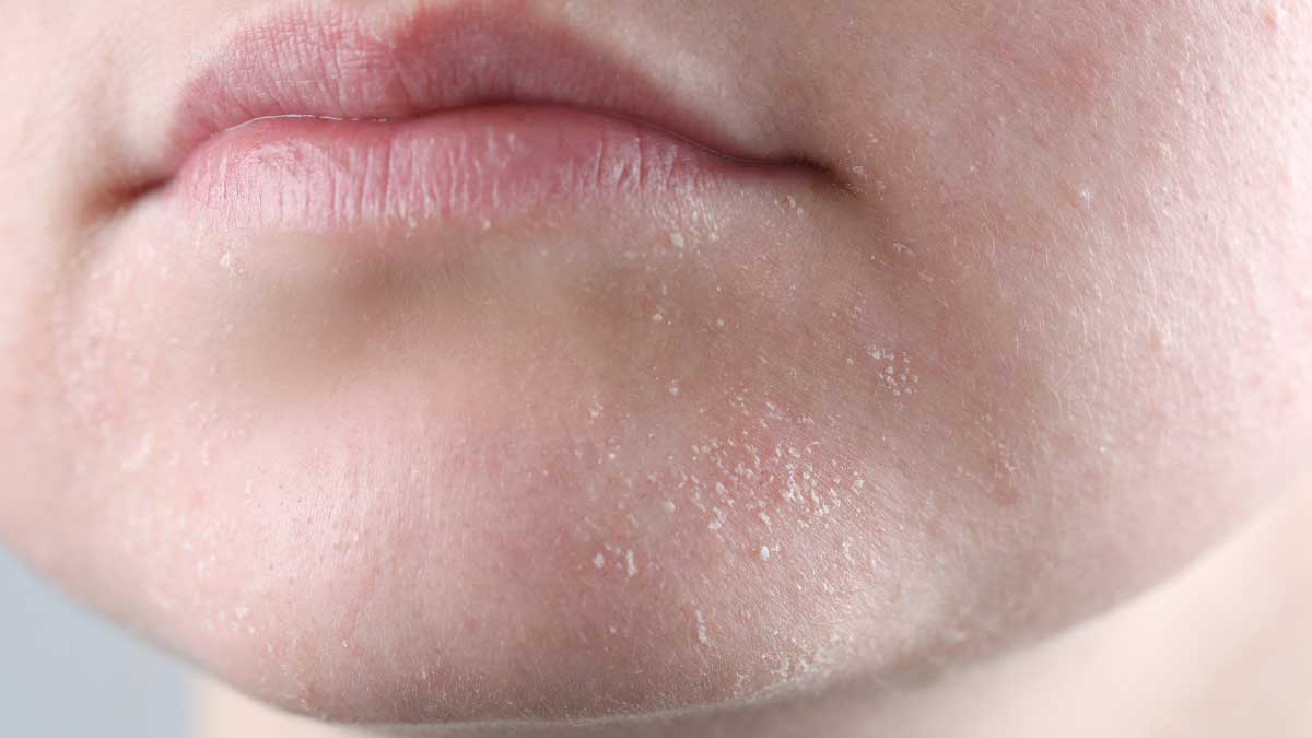 Eliminate Dry Skin the magic of home remedies!