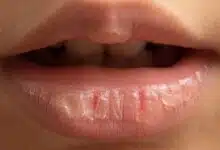 Lip balm heals Chapped Lips, choose the right product.