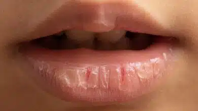 Lip balm heals Chapped Lips, choose the right product.