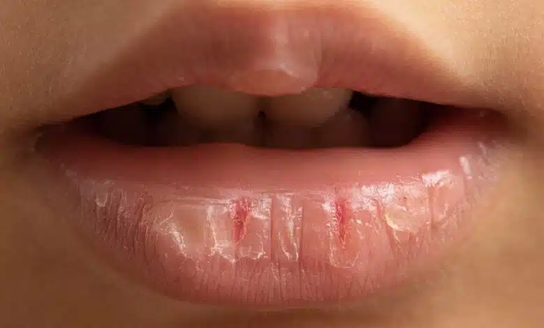 Lip balm heals Chapped Lips, choose the right product.