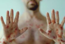 New variant of monkeypox: Safety measures!
