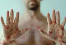 New variant of monkeypox: Safety measures!