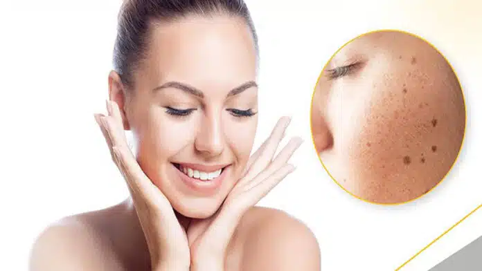 Pigmentation problem Try these 5 easy home remedies