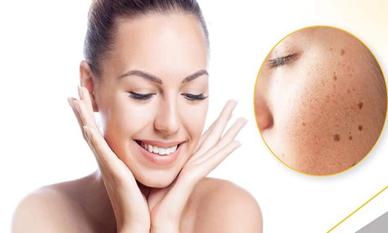 Pigmentation problem Try these 5 easy home remedies