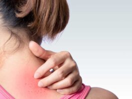 Rashes caused by sweat Get relief with these remedies!