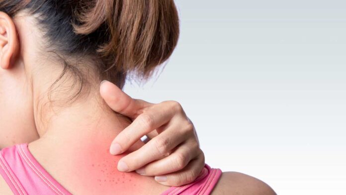 Rashes caused by sweat Get relief with these remedies!