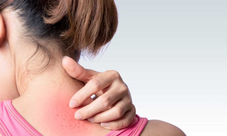 Rashes caused by sweat Get relief with these remedies!