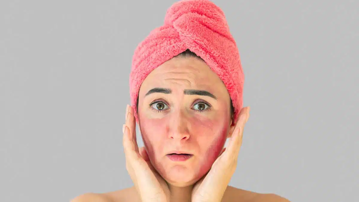 Rashes caused by sweat Get relief with these remedies!