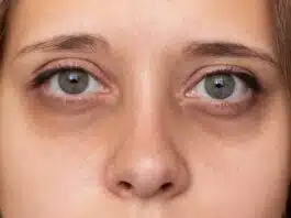Remove Dark Circles under eyes! Get beautiful and glowing skin