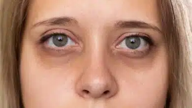 Remove Dark Circles under eyes! Get beautiful and glowing skin